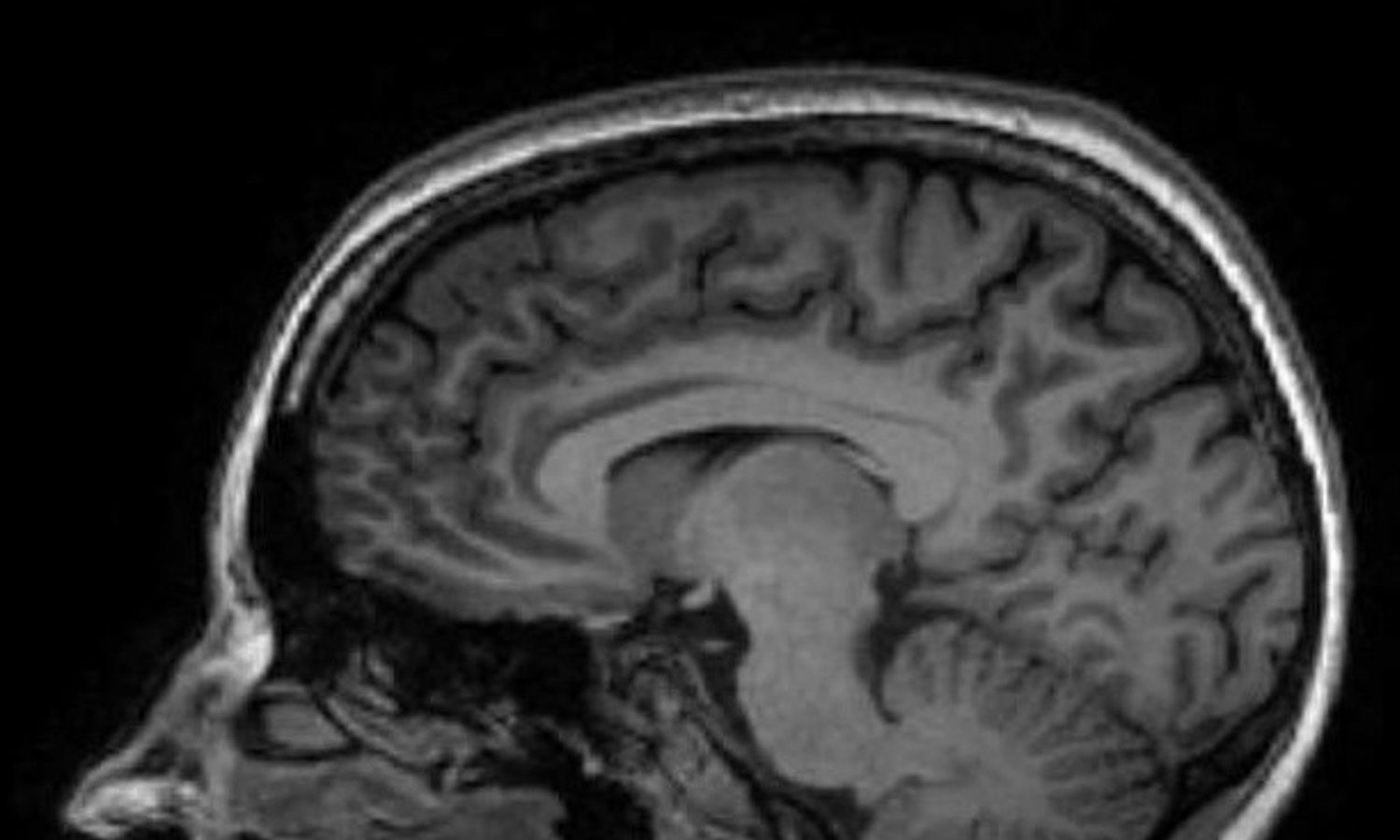 Jane Elizabeth Bennett MRI Scan, Kings College London Autistica